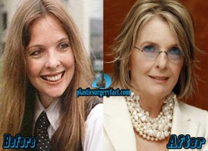 Diane Keaton Plastic Surgery Secrets Revealed