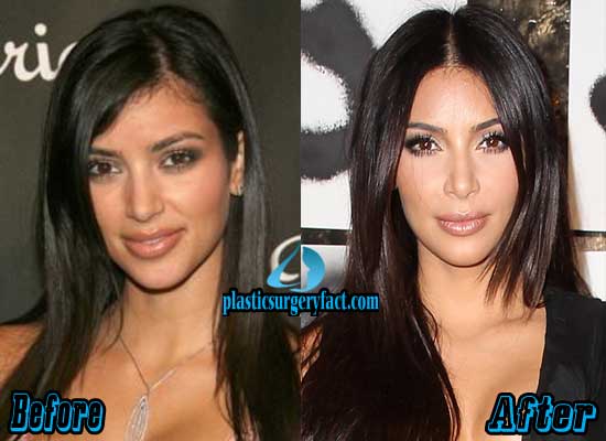 Kim Kardashian Nose Job Before and After