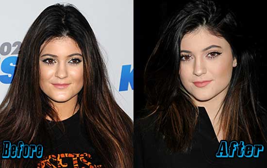 Kylie Jenner Plastic Surgery Before and After