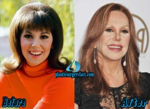 Marlo Thomas Plastic Surgery Before and After - Plastic Surgery Facts