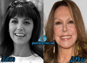 Marlo Thomas Plastic Surgery Before and After - Plastic Surgery Facts