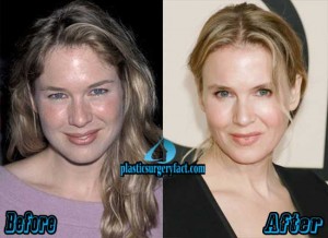 Renee Zellweger Plastic Surgery Before and After - Plastic Surgery Facts