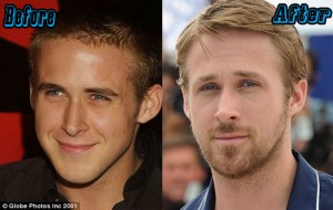 Top 10 Celebrities with Nose Jobs Before and After
