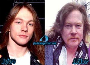 Axl Rose Plastic Surgery Before and After Photos - Plastic Surgery Facts