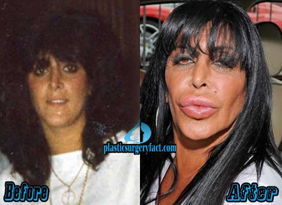Worst Celebrity Plastic Surgery Ever: Before and After - Plastic ...