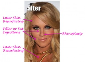 Jenny Mccarthy Plastic Surgery Before and After