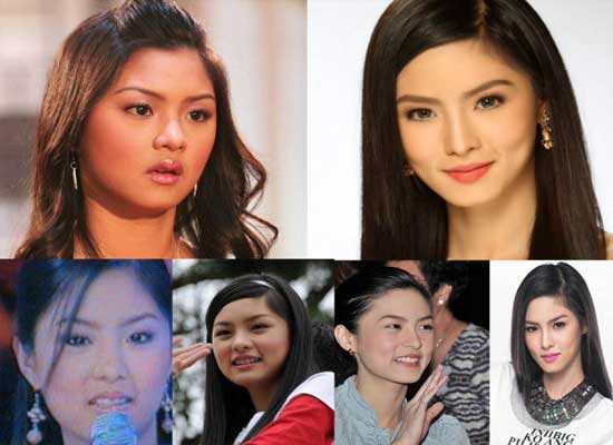 Kim Chiu Plastic Surgery Before and After Photos