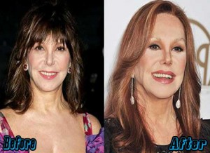 Marlo Thomas Plastic Surgery Before and After Photos - Plastic Surgery ...