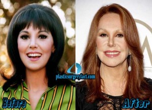 Marlo Thomas Plastic Surgery Before and After Photos - Plastic Surgery ...