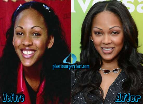 Meagan Good Before and After Plastic Surgery.