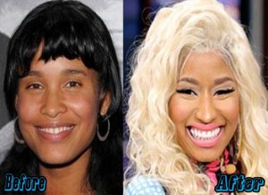 Did Nicki Minaj Have Plastic Surgery