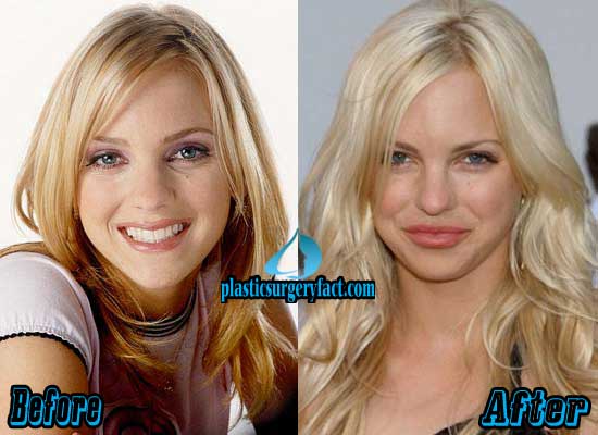 Anna Faris Plastic Surgery Before and After Photos