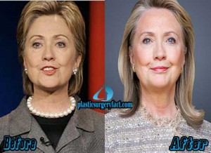 Hillary Clinton Plastic Surgery: Facelift and Botox - Plastic Surgery Facts