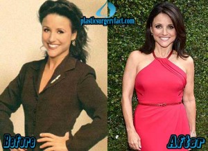Julia Louis-Dreyfus Plastic Surgery Before and After
