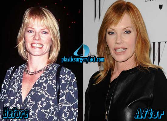 Marg Helgenberger Plastic Surgery Before and After - Plastic