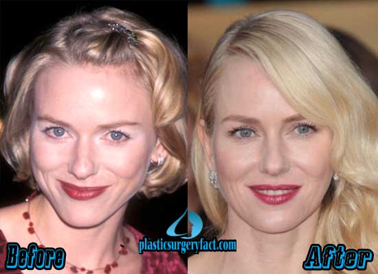 Naomi Watts Plastic Surgery Before and After.