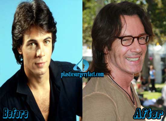 Rick Springfield Plastic Surgery Before and After.