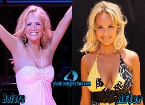 Kristin Chenoweth Plastic Surgery Before and After