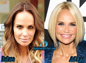 Kristin Chenoweth Plastic Surgery Before and After
