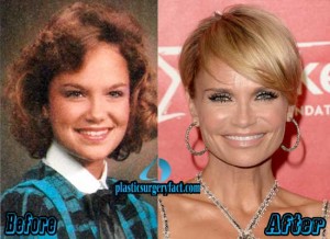 Kristin Chenoweth Plastic Surgery Before and After