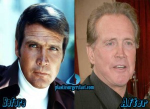 Lee Majors Nose Job