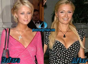 Paris Hilton Breast Implants: Fact or Rumor