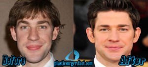 krasinski rhinoplasty