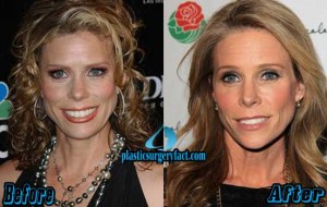 Cheryl Hines Plastic Surgery Before After Defends