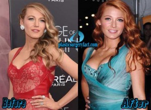 List of Celebrities with Breast Implants Before And After Pictures