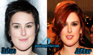 Rumer Willis Archives - Plastic Surgery Facts