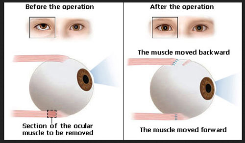 lazy-eye-surgery-before-after-cost-and-treatments-plastic-surgery-facts