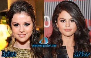 Selena Gomez Nose Job Before and After
