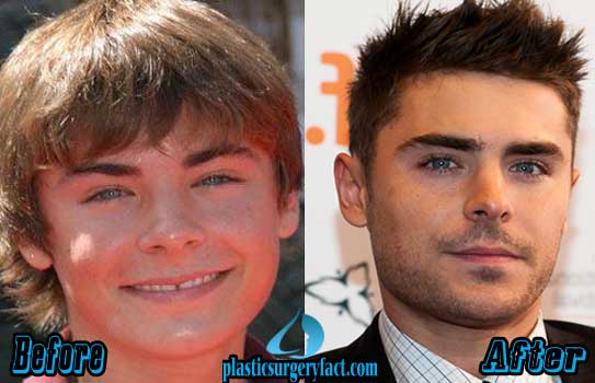 Zac Efron Nose Job Before and After Pictures - Plastic Surgery Facts