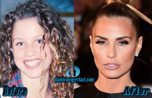 Katie Price Plastic Surgery | Katie Price Before and After Veneers