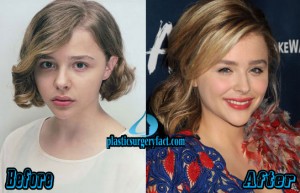 Chloe Grace Moretz Plastic Surgery: Facts or Rumors? - Plastic Surgery ...