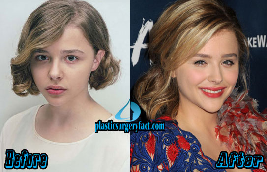 Chloë Grace Moretz Plastic Surgery Speculation Nose Job & Lip Fillers