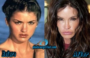 Too Much Plastic Surgery Before and After | Worst Celebrity Plastic Surgery