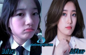 Suzy Bae Plastic Surgery | Suzy Bae Pictures Before and After - Plastic ...
