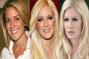 celebrity plastic surgery