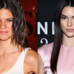 Kеndаll Jenner plastic surgery Before and After