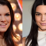 Kеndаll Jenner plastic surgery Before and After