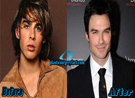 Before and After: Ian Somerhalder's Journey Through Plastic Surgery