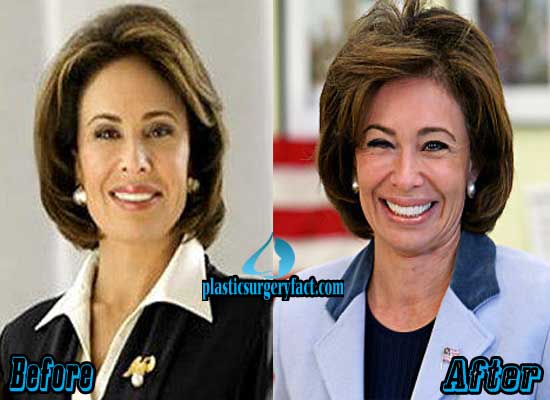 The Impact of Jeanine Pirro's Plastic Surgery on Her Career