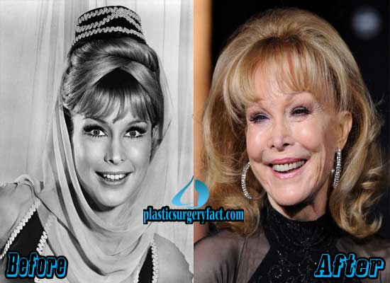 Understanding the Impact of Barbara Eden's Cosmetic Procedures
