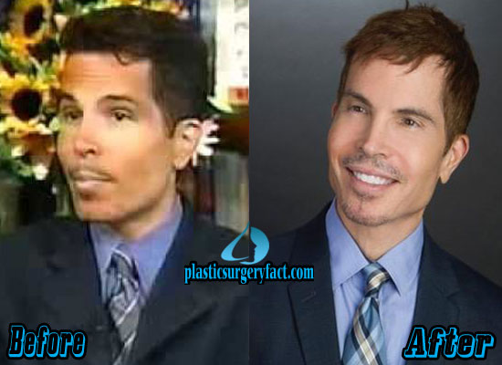 Before and After: Discovering Gerald Posner's Plastic Surgery Changes