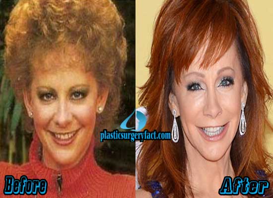 Before and After: The Impact of Reba McEntire's Cosmetic Procedures