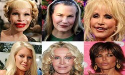 Botched Plastic Surgery Photos Before and After